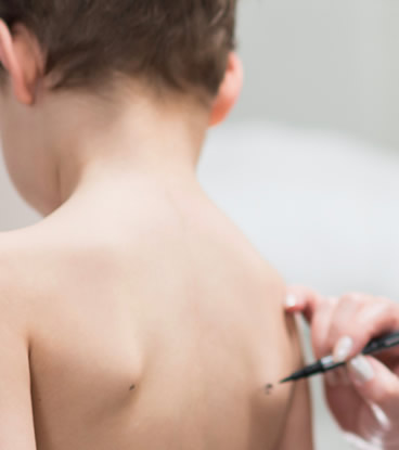 How to Fix Winged Shoulder Blades